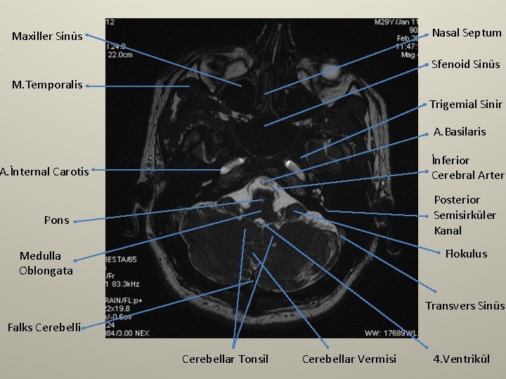 Nasal Septum Maxiller Sinüs Sfenoid Sinüs M. Temporalis Trigemial Sinir A. Basilaris İnferior Cerebral