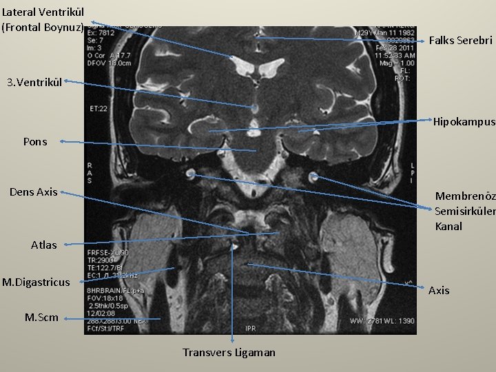 Lateral Ventrikül (Frontal Boynuz) Falks Serebri 3. Ventrikül Hipokampus Pons Dens Axis Membrenöz Semisirküler