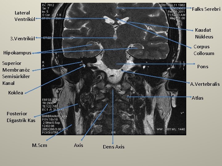 Falks Serebri Lateral Ventrikül Kaudat Nükleus 3. Ventrikül Corpus Collosum Hipokampus Superior Membranöz Semisürkiler