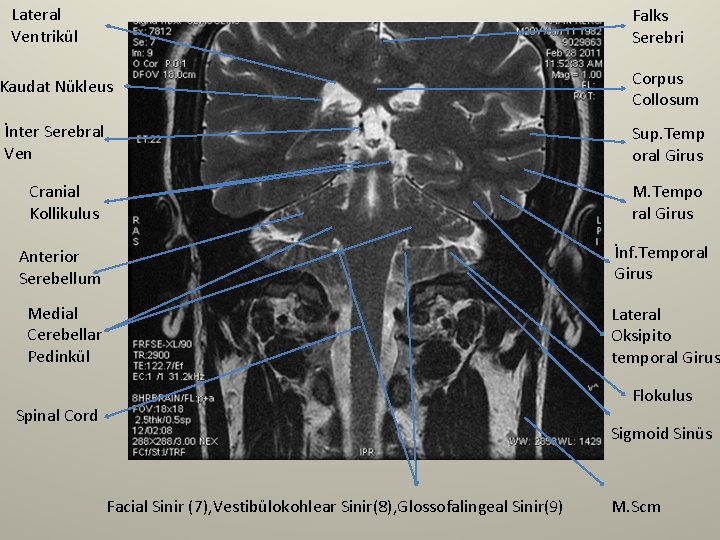 Lateral Ventrikül Falks Serebri Kaudat Nükleus Corpus Collosum İnter Serebral Ven Sup. Temp oral