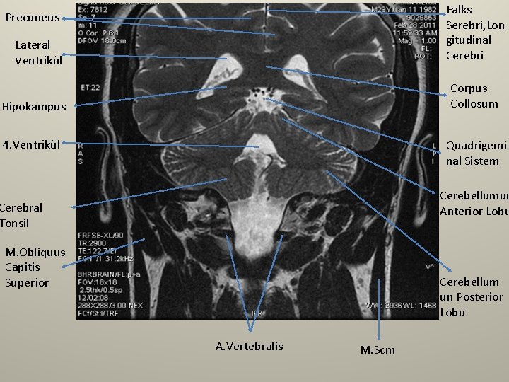 Falks Serebri, Lon gitudinal Cerebri Precuneus Lateral Ventrikül Corpus Collosum Hipokampus 4. Ventrikül Quadrigemi