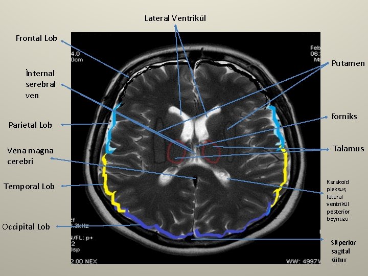 Lateral Ventrikül Frontal Lob İnternal serebral ven Parietal Lob Vena magna cerebri Temporal Lob