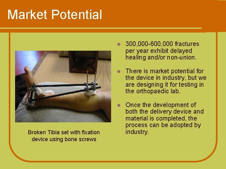 Market Potential Broken Tibia set with fixation device using bone screws l 300, 000