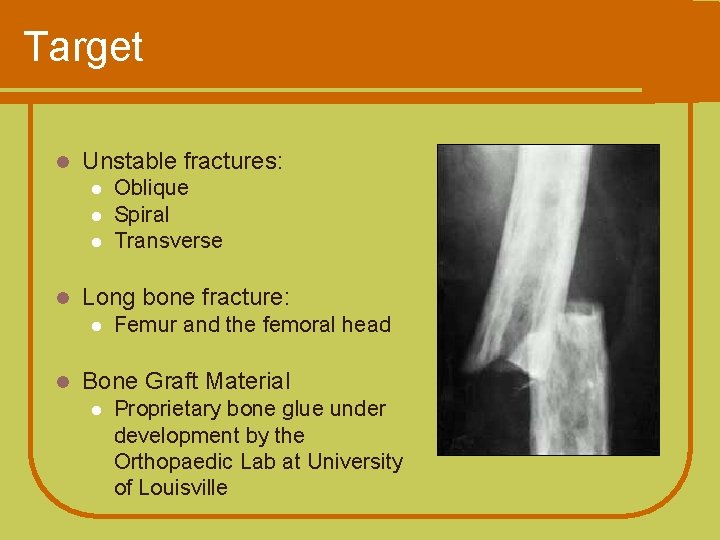 Target l Unstable fractures: l l Long bone fracture: l l Oblique Spiral Transverse