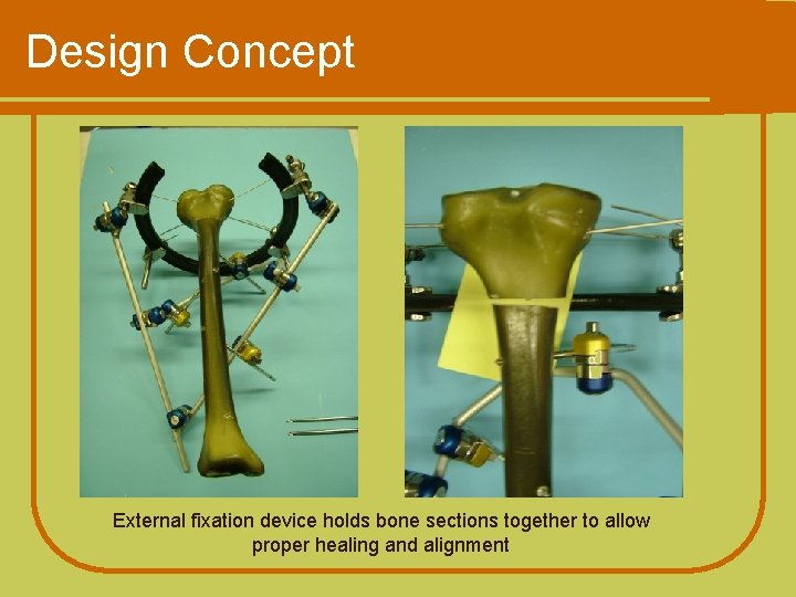 Design Concept External fixation device holds bone sections together to allow proper healing and