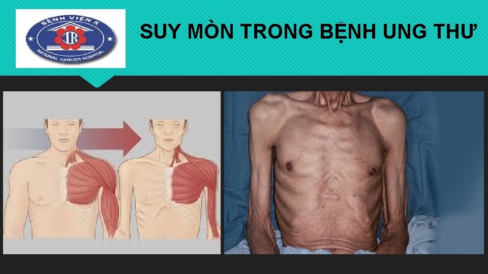 SUY MÒN TRONG BỆNH UNG THƯ 