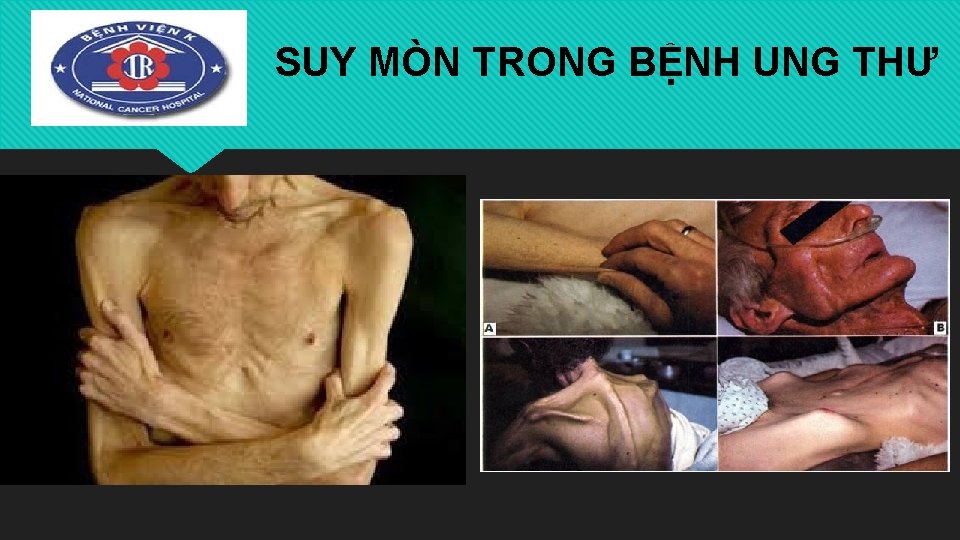 SUY MÒN TRONG BỆNH UNG THƯ 
