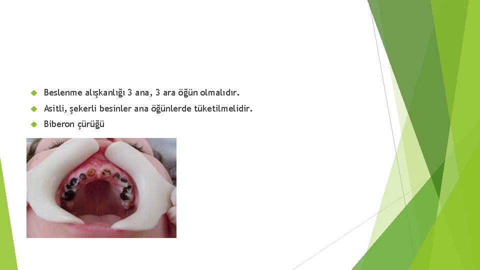  Beslenme alışkanlığı 3 ana, 3 ara öğün olmalıdır. Asitli, şekerli besinler ana öğünlerde