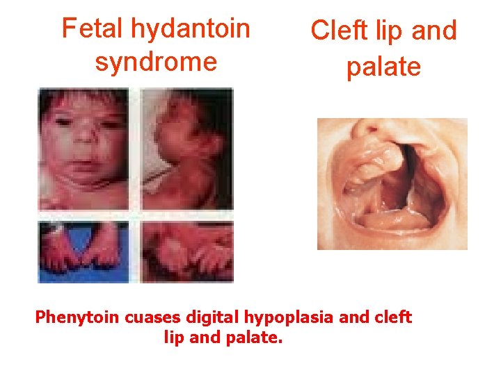 Fetal hydantoin syndrome Cleft lip and palate Phenytoin cuases digital hypoplasia and cleft lip