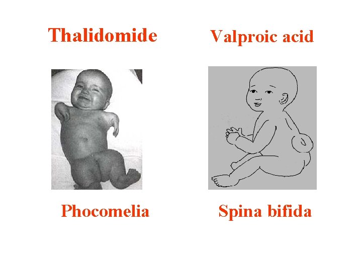 Thalidomide Valproic acid Phocomelia Spina bifida 