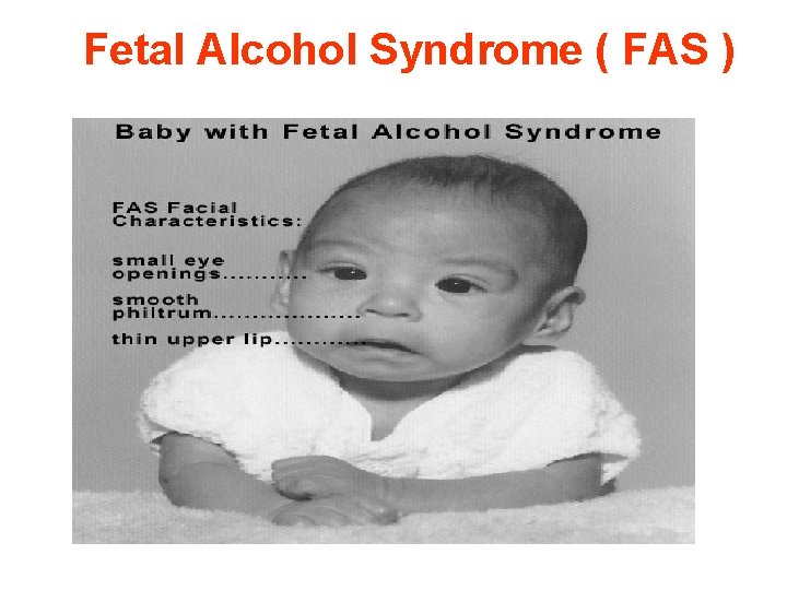 Fetal Alcohol Syndrome ( FAS ) 