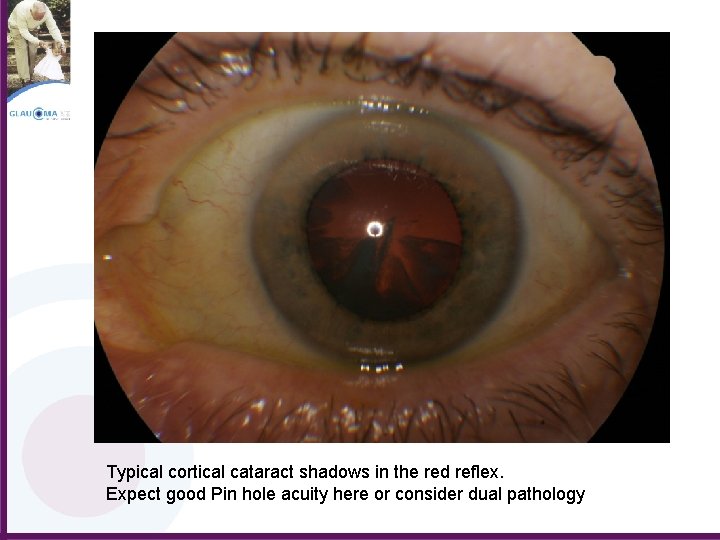 Typical cortical cataract shadows in the red reflex. Expect good Pin hole acuity here