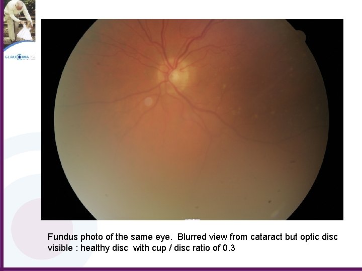 Fundus photo of the same eye. Blurred view from cataract but optic disc visible