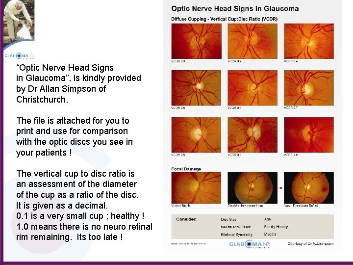 “Optic Nerve Head Signs in Glaucoma”, is kindly provided by Dr Allan Simpson of
