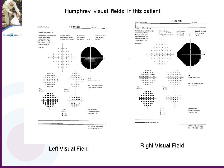 Humphrey visual fields in this patient Left Visual Field Right Visual Field 