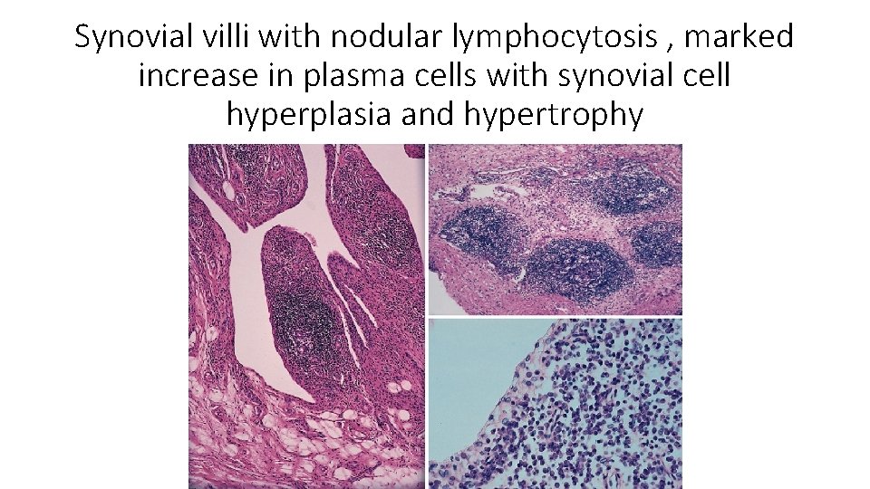 Synovial villi with nodular lymphocytosis , marked increase in plasma cells with synovial cell