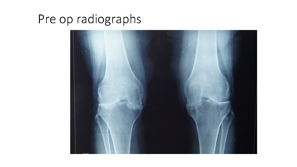 Pre op radiographs 