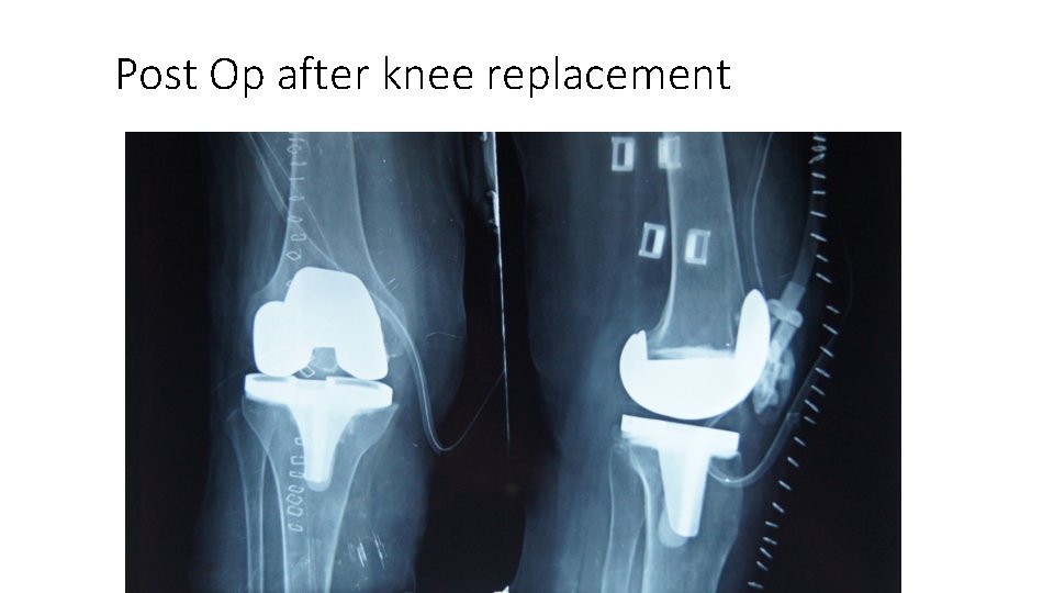 Post Op after knee replacement 