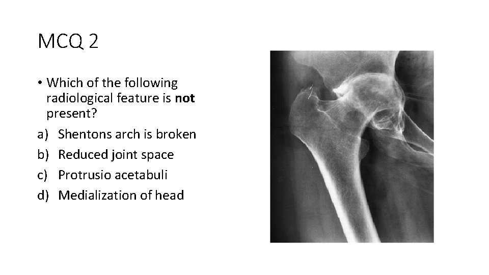 MCQ 2 • Which of the following radiological feature is not present? a) Shentons