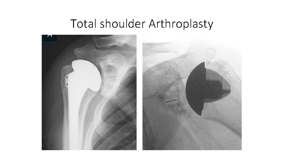 Total shoulder Arthroplasty 