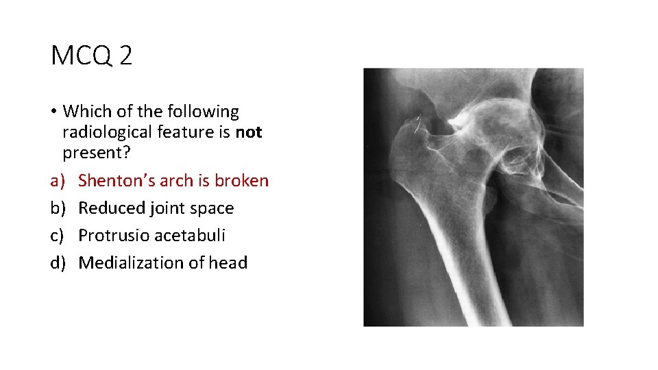 MCQ 2 • Which of the following radiological feature is not present? a) Shenton’s