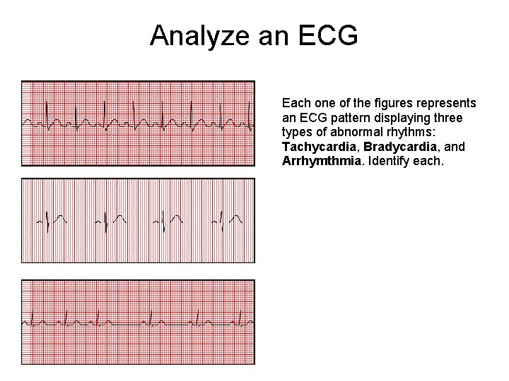 Analyze an ECG Each one of the figures represents an ECG pattern displaying three Analyze an ECG Each one of the figures represents an ECG pattern displaying three