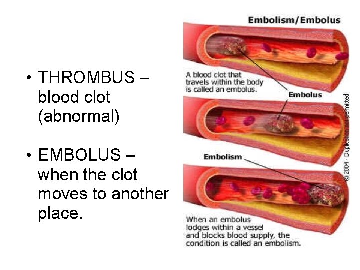 • THROMBUS – blood clot (abnormal) • EMBOLUS – when the clot moves  • THROMBUS – blood clot (abnormal) • EMBOLUS – when the clot moves