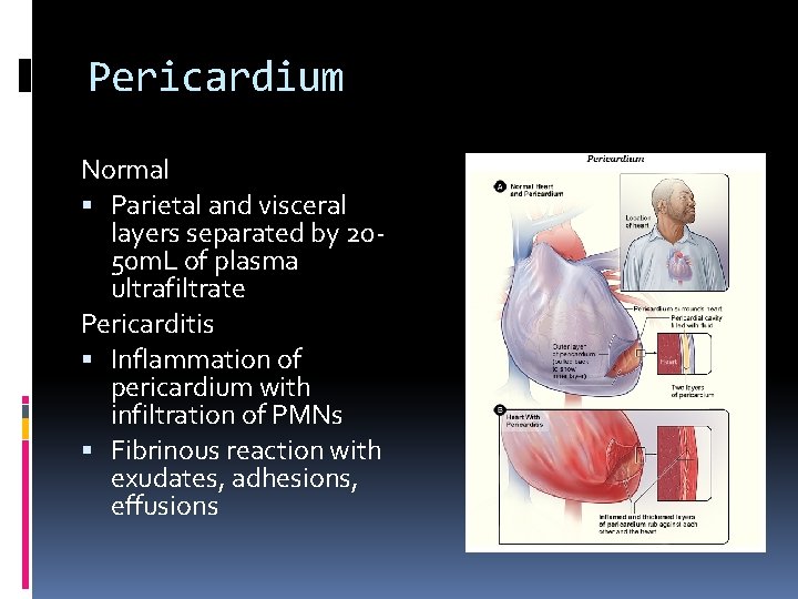 Pericardium Normal Parietal and visceral layers separated by 2050 m. L of plasma ultrafiltrate
