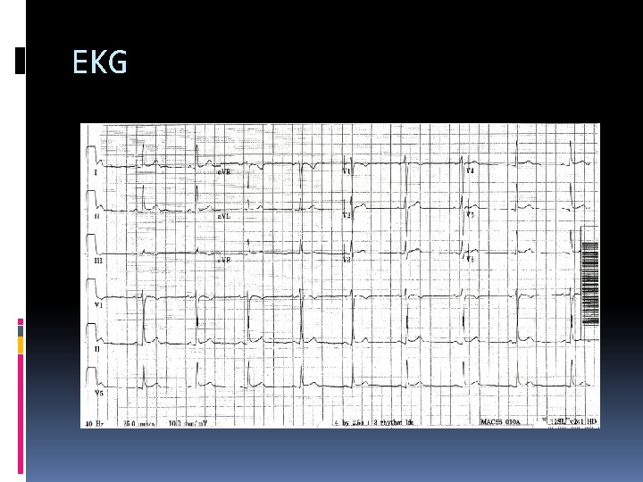 EKG 