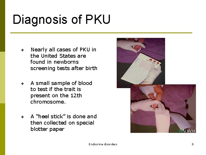 Diagnosis of PKU v v v Nearly all cases of PKU in the United