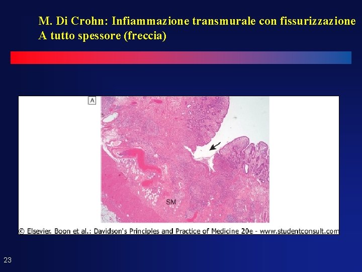 M. Di Crohn: Infiammazione transmurale con fissurizzazione A tutto spessore (freccia) 23 