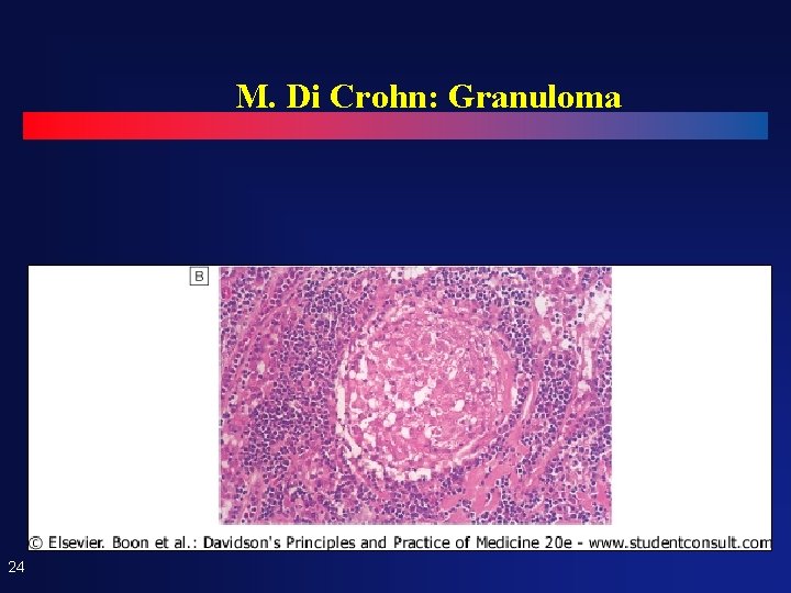 M. Di Crohn: Granuloma 24 