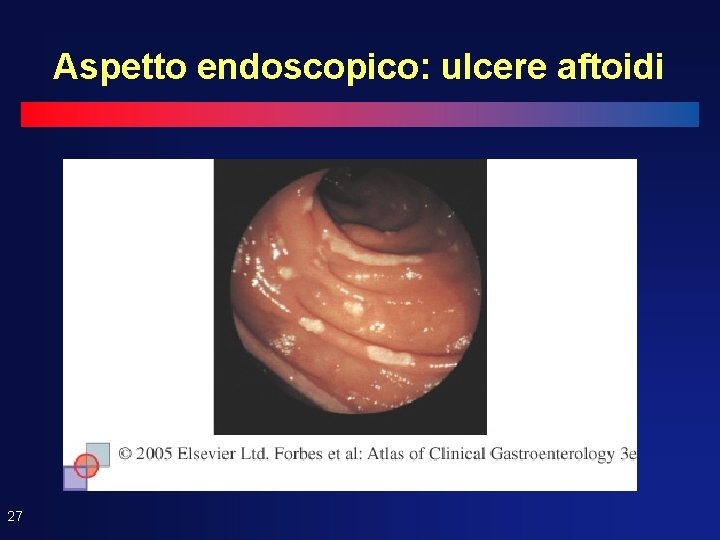 Aspetto endoscopico: ulcere aftoidi 27 