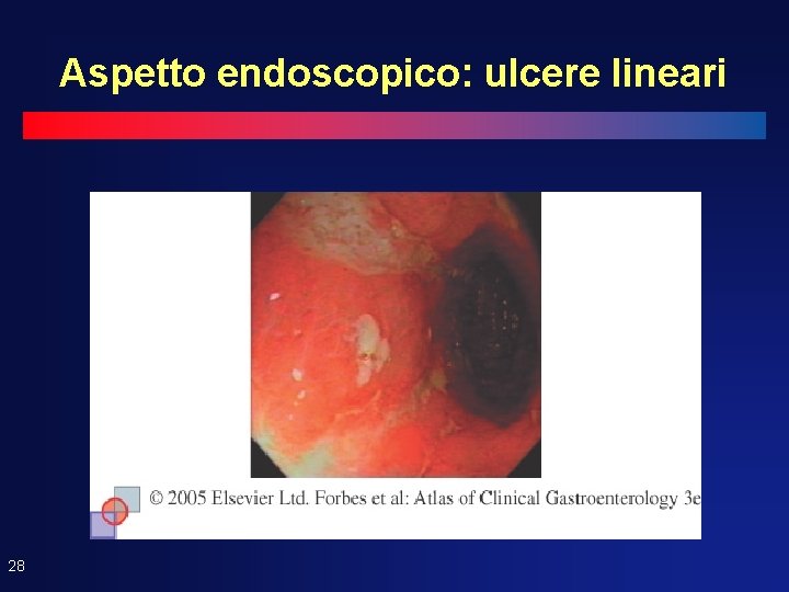 Aspetto endoscopico: ulcere lineari 28 