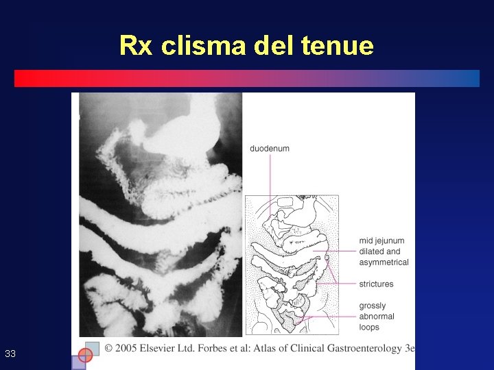 Rx clisma del tenue 33 