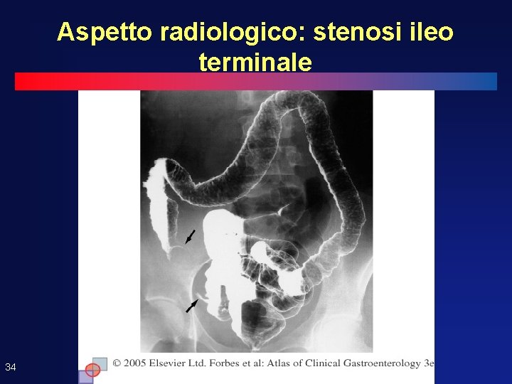 Aspetto radiologico: stenosi ileo terminale 34 