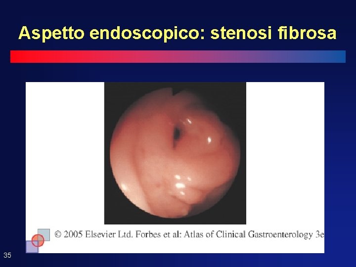 Aspetto endoscopico: stenosi fibrosa 35 