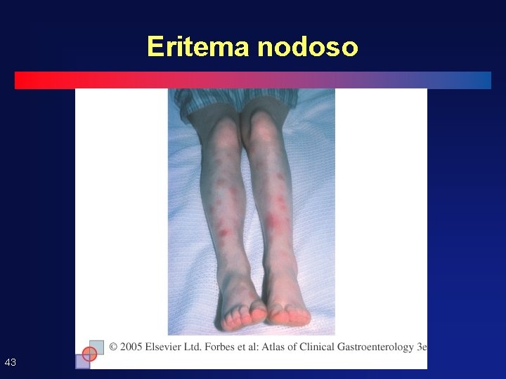 Eritema nodoso 43 