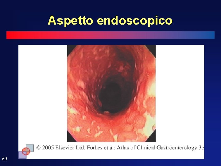 Aspetto endoscopico 69 