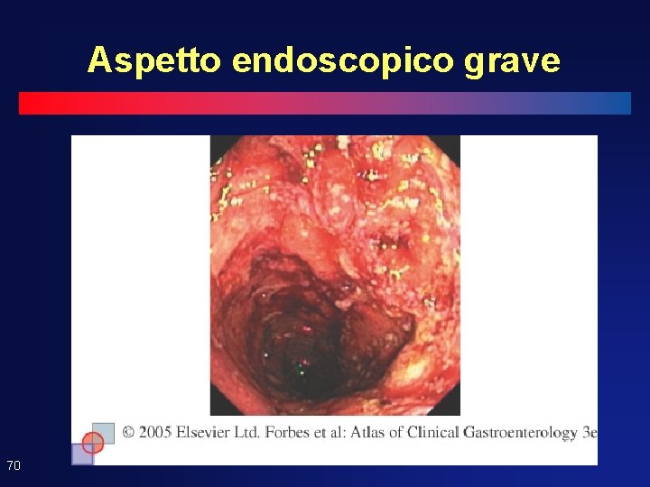 Aspetto endoscopico grave 70 