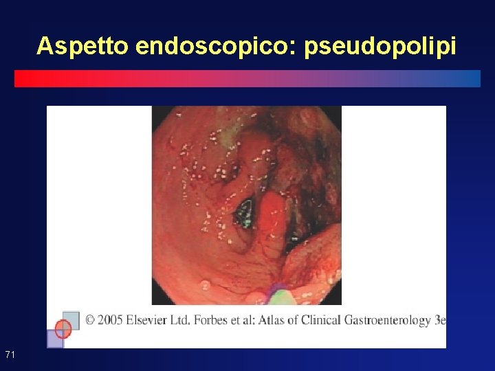 Aspetto endoscopico: pseudopolipi 71 
