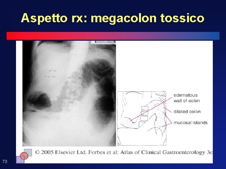 Aspetto rx: megacolon tossico 73 