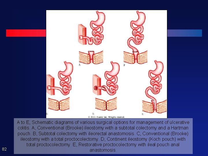 82 A to E, Schematic diagrams of various surgical options for management of ulcerative