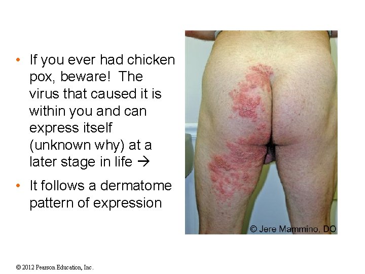  • If you ever had chicken pox, beware! The virus that caused it