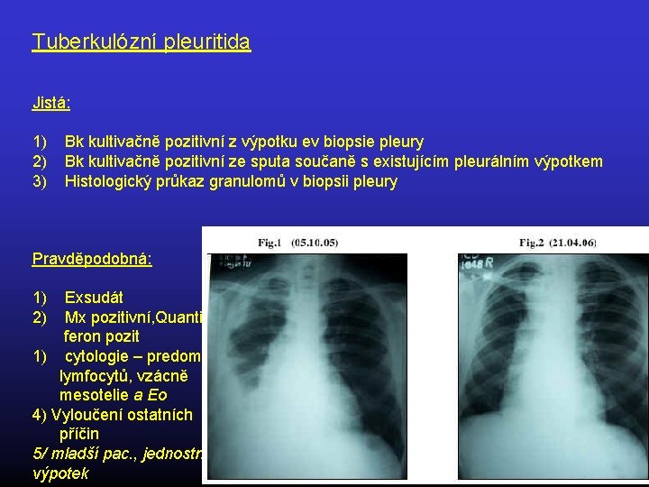 Tuberkulózní pleuritida Jistá: 1) 2) 3) Bk kultivačně pozitivní z výpotku ev biopsie pleury