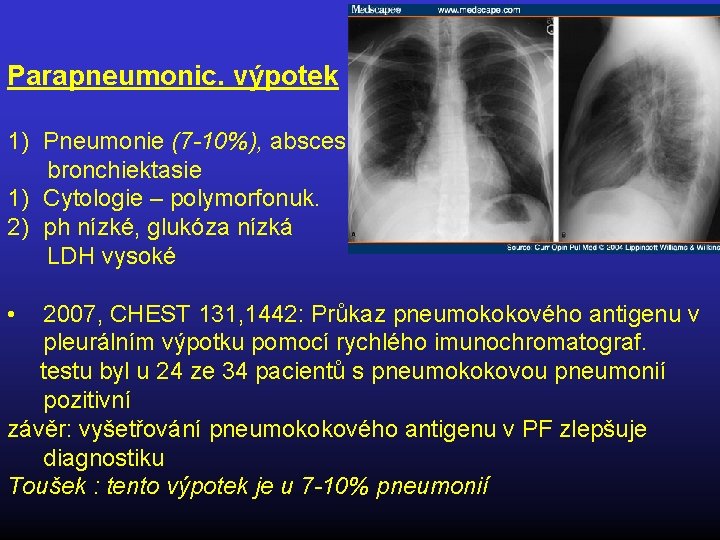 Parapneumonic. výpotek 1) Pneumonie (7 -10%), absces, bronchiektasie 1) Cytologie – polymorfonuk. 2) ph