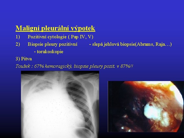 Maligní pleurální výpotek 1) 2) Pozitivní cytologie ( Pap IV, V) Biopsie pleury pozitivní