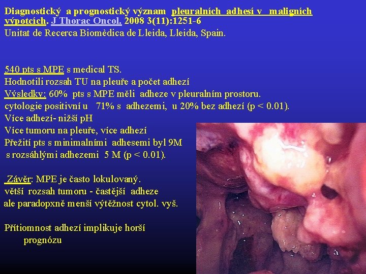 Diagnostický a prognostický význam pleuralních adhesí v maligních výpotcích. J Thorac Oncol. 2008 3(11):