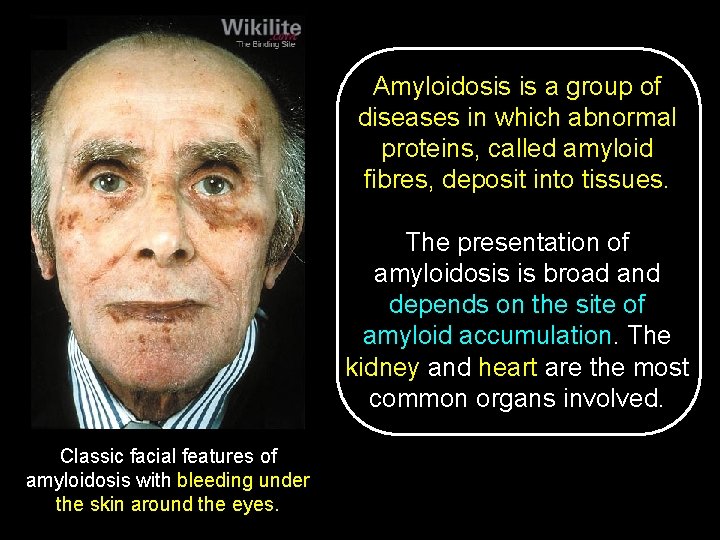 Amyloidosis is a group of diseases in which abnormal proteins, called amyloid fibres, deposit