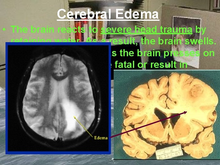 Cerebral Edema • The brain reacts to severe head trauma by retaining water. As